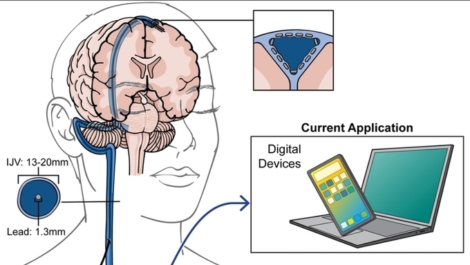 中화산병원·뇌후과기 협력, 내장 배터리 전면 무선화
