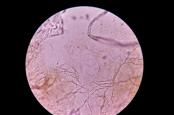 성관계 통해 확산된 희귀 곰팡이, '이곳' 비상